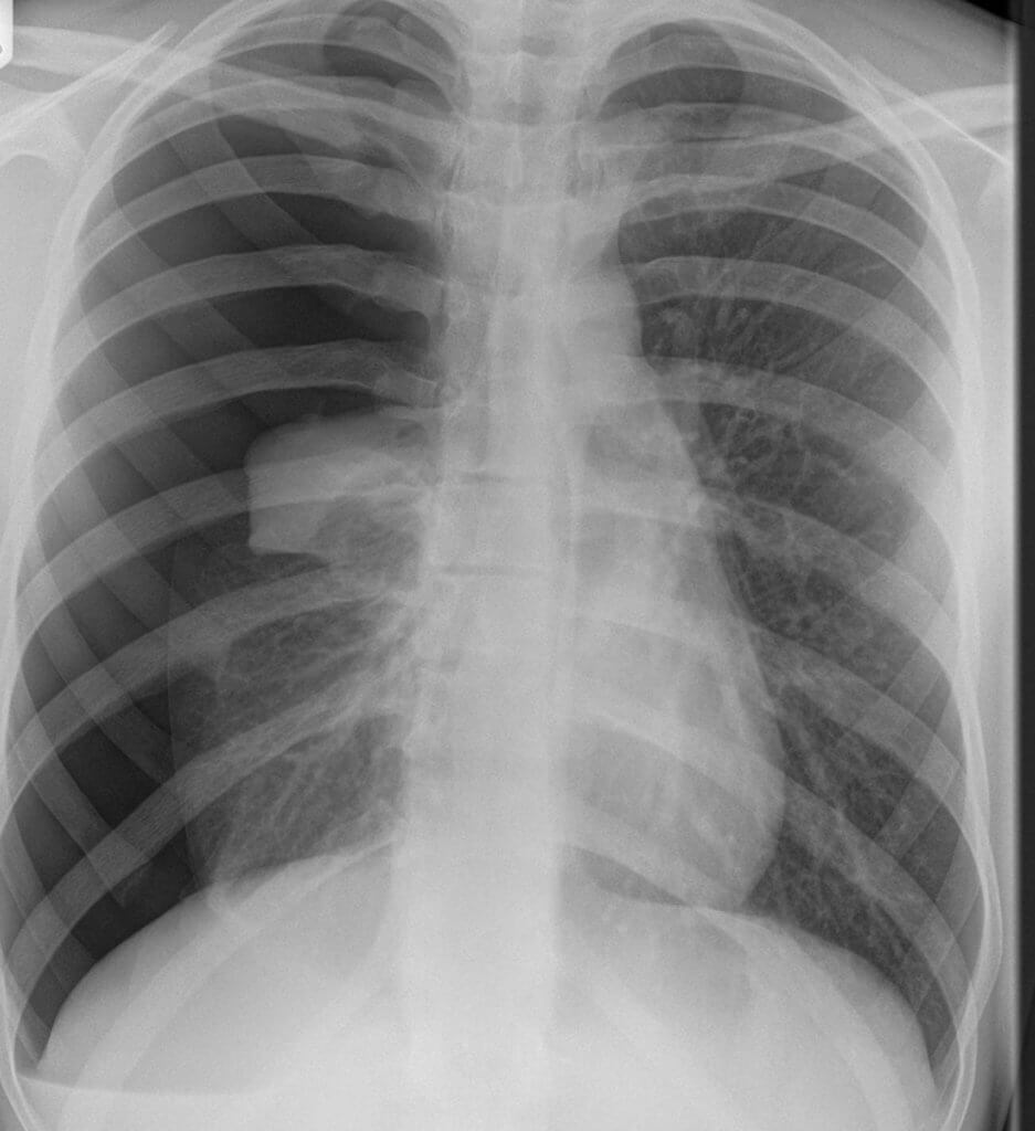 X光片顯示氣胸患者的肺部有氣泡